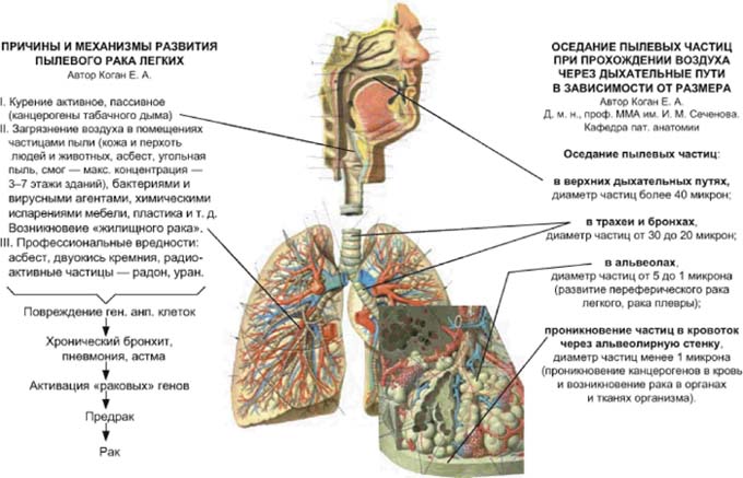 Стадии рака легкого картинки